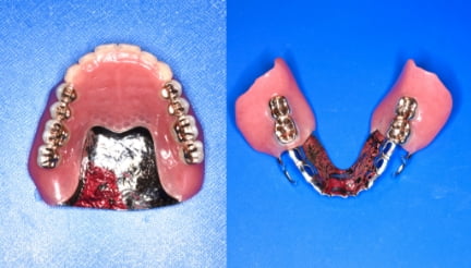 金属床義歯の写真